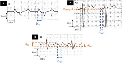 ECG Predictors for New-Onset Atrial Fibrillation Within a Year After Radiofrequency Ablation of Counterclockwise-Rotating Atrial Flutter